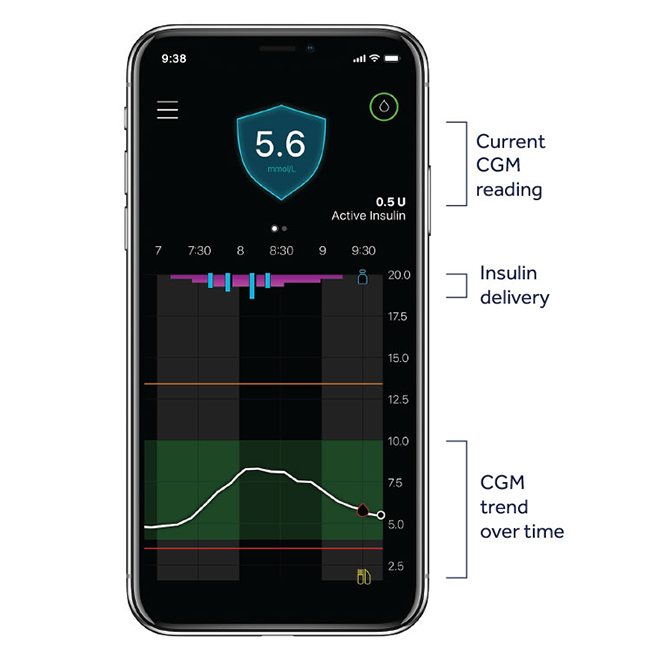 MiniMed™ 780G with Guardian™ 4 Sensor